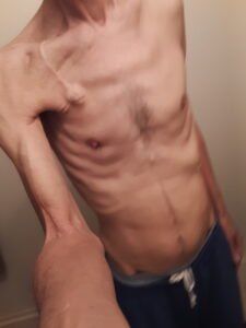 my-cancer-survivor-story-with-chemo-port