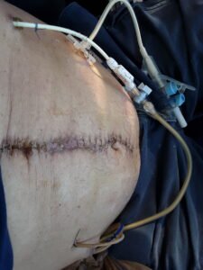 patient-with-stomach-surgery-scars
